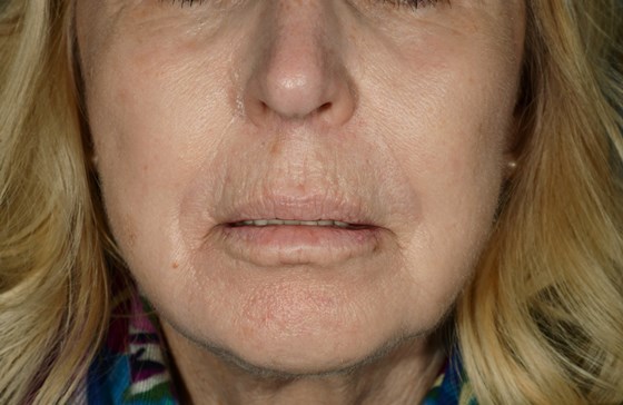 Michael Kulick, MD: An Overview of Lip Augmentation