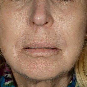 Michael Kulick, MD: An Overview of Lip Augmentation